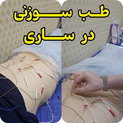 طب سوزنی در ساری