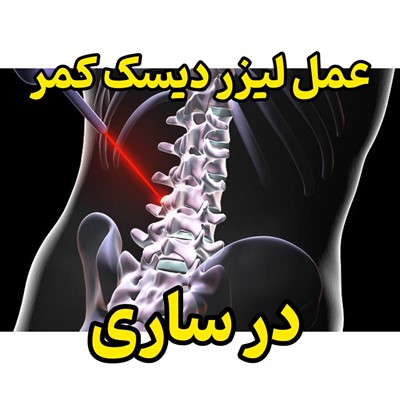 عمل لیزر دیسک کمر در ساری