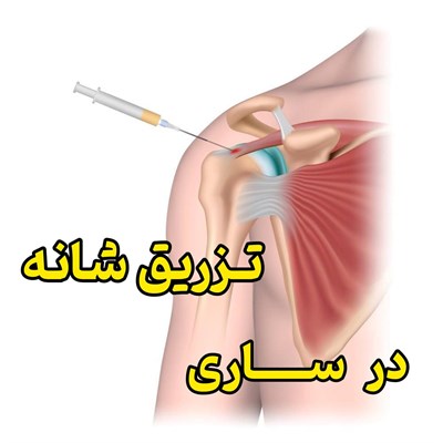 تزریق شانه در ساری