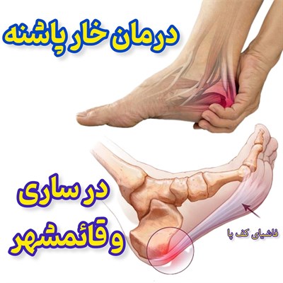 درمان خار پاشنه در ساری و قائمشهر