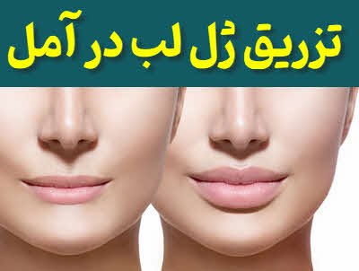 تزریق ژل لب آمل