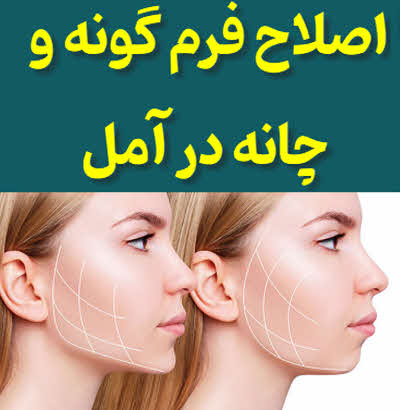 اصلاح فرم گونه و چانه آمل