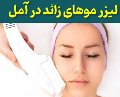 لیزر مو آمل