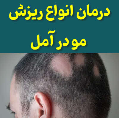 درمان ریزش مو آمل