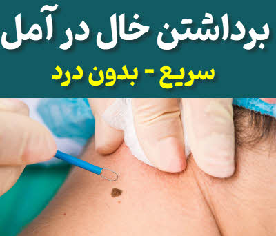 برداشتن خال آمل