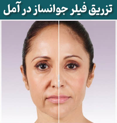 تزریق فیلر جوانساز آمل