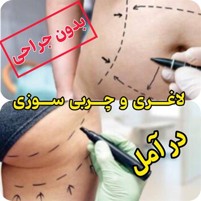 لاغری و چربی سوزی بدون جراحی در آمل