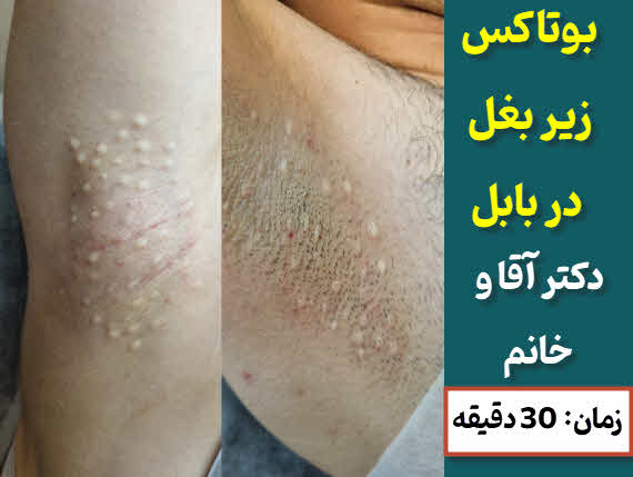 بوتاکس  زیر بغل بابل