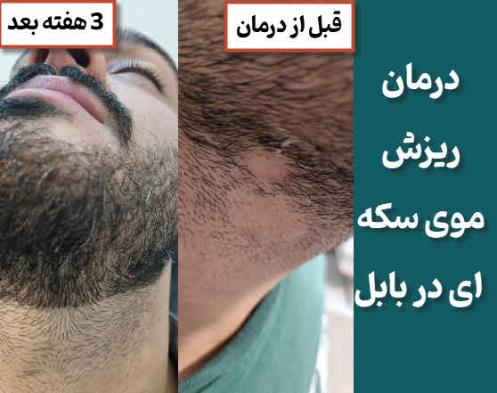 درمان ریزش سکه ای مو - بابل