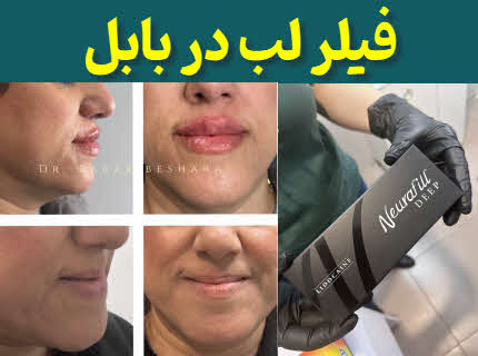 فیلر لب بابل