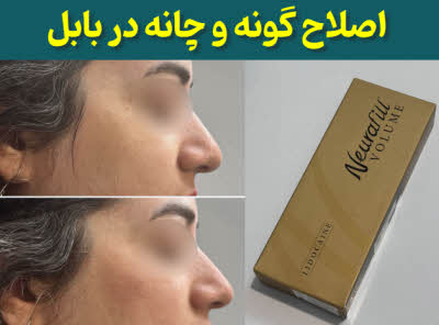 اصلاح گونه و چانه بابل
