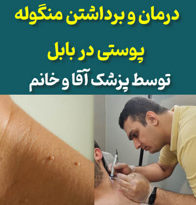 درمان و برداشتن منگوله پوستی (اسکین تگ) بابل
