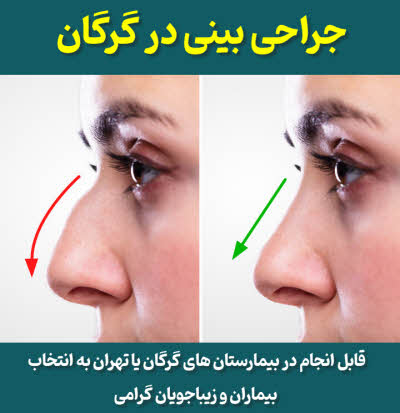 جراحی بینی در گرگان