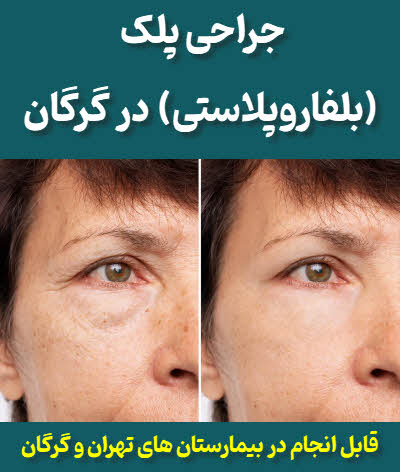 جراحی افتادگی پلک (بلفاروپلاستی) در گرگان