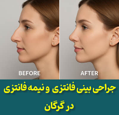 جراحی بینی فانتزی و نیمه فانتزی گرگان