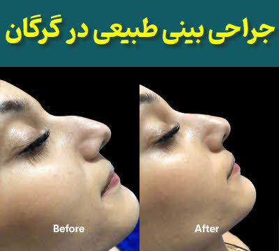 جراحی بینی طبیعی گرگان