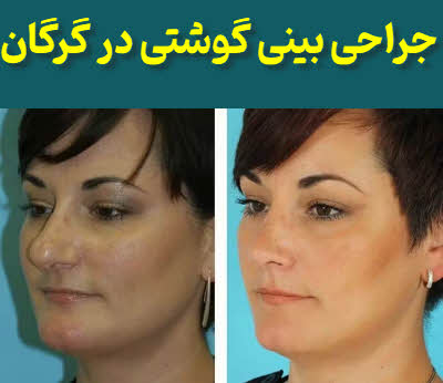 جراحی بینی گوشتی گرگان