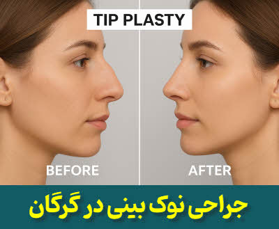 جراحی نوک بینی  (تیپ پلاستی) گرگان | دکتر محمد کردجزی