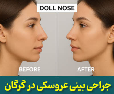 جراحی بینی عروسکی گرگان | دکتر محمد کردجزی