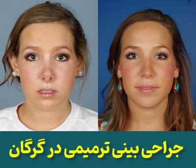 جراحی بینی ترمیمی گرگان | دکتر محمد کردجزی متخصص گوش و حلق و بینی