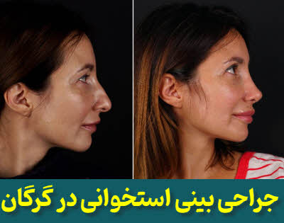 جراحی بینی استخوانی گرگان | دکتر محمد کردجزی | متخصص گوش و حلق و بینی