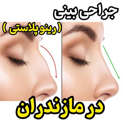 جراحی بینی (عمل رینوپلاستی) مازندران