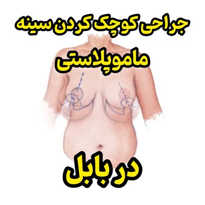 جراحی کوچک کردن سینه (ماموپلاستی) در بابل
