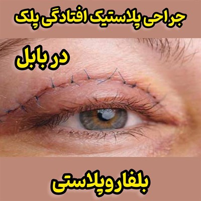 جراحی پلاستیک افتادگی پلک در بابل