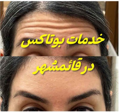 بوتاکس قائمشهر