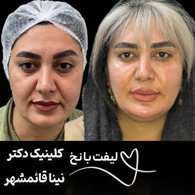 لیفت با نخ قائمشهر