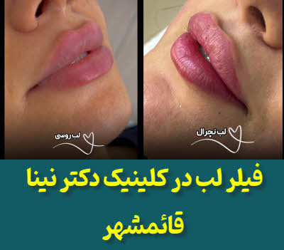 فیلر لب قائمشهر