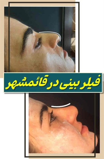 فیلر بینی قائمشهر