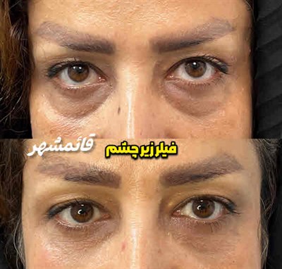 فیلر زیر چشم قائمشهر